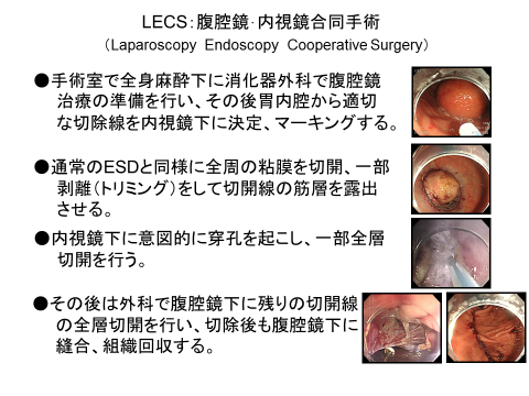 LECS　腹腔鏡・内視鏡合同手術１