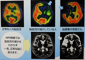 脳血流シンチグラフィ画像