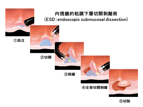 内視鏡的粘膜下層切開剥離術（ESD:endoscopic submucosal dissection）