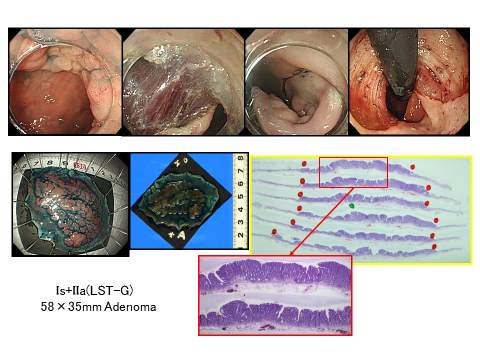 （例）大きな病変で通常の内視鏡切除が難しい病変画像