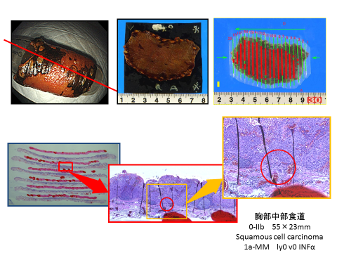 （例）食道全周を占める大きな病変（全周粘膜切除症例）画像２