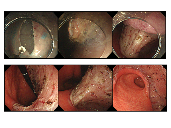 （例）胃角部後壁の広範囲病変画像２