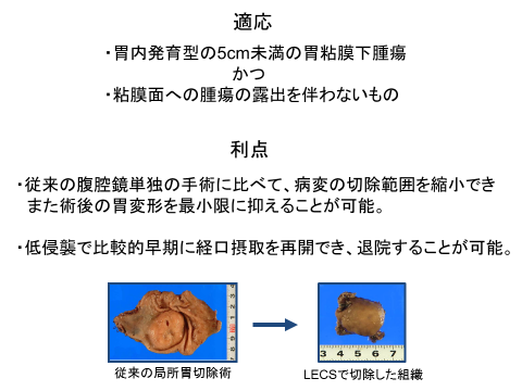 LECS　腹腔鏡・内視鏡合同手術２