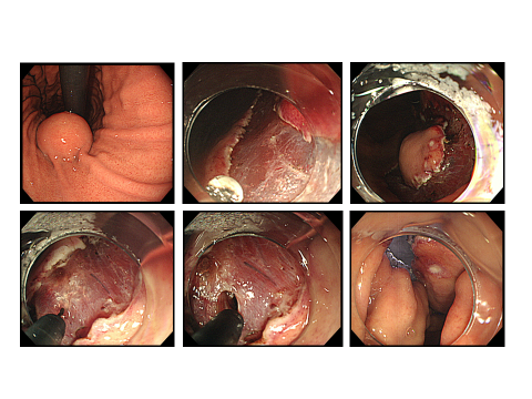 例）胃体上部小弯の胃粘膜下腫瘍画像