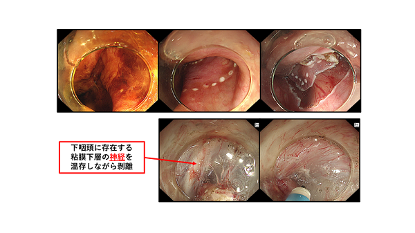 下咽頭癌手術1