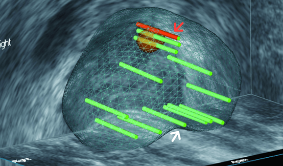 (図2)ターゲットに正確に穿刺した生検針の軌跡。微小がんの検出のため系統的多所生検も併せて行います。