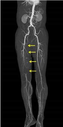 閉塞性動脈硬化症の画像