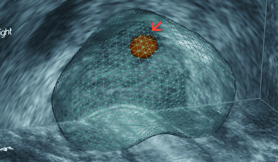 (図1)MRIで指摘された前立腺癌を疑うターゲット