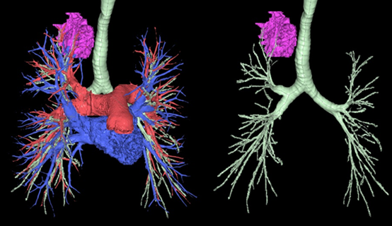 肺動静脈3D画像