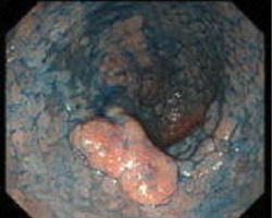 胃内視鏡検査：胃粘膜内がんの画像