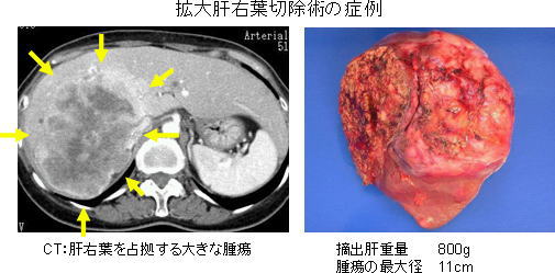 拡大肝右葉切除術の症例（画像）